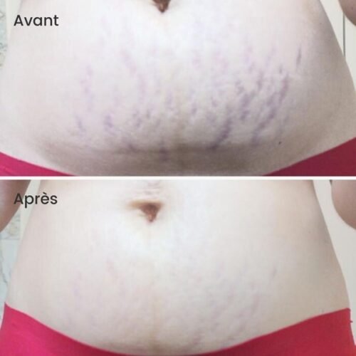 SOS Stretch Marks Balm - 100% MOM - 4 SOS Stretch Marks Balm - 100% MOM (100 ml)